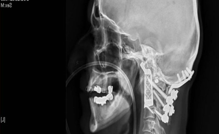 Gydytojai pirmą kartą implantavo 3D spausdintuvu pagamintą slankstelį